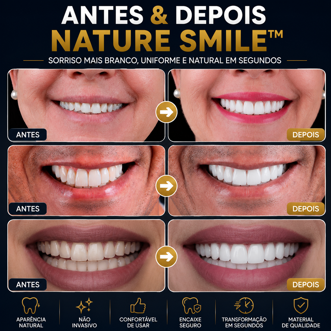 Nature Smile® - Facetas Dentárias Removíveis
