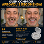 Nature Smile® - Facetas Dentárias Removíveis