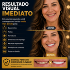 Nature Smile® - Facetas Dentárias Removíveis