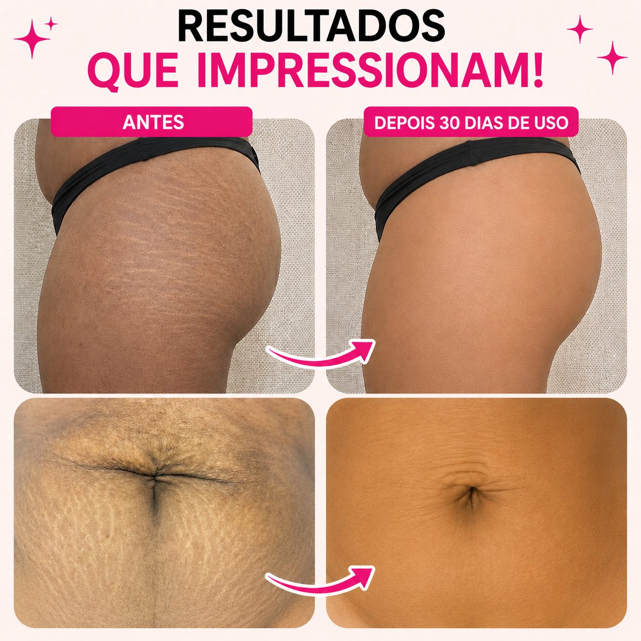 BellaFirm™ Tratamento Intensivo para Estrias e Flacidez