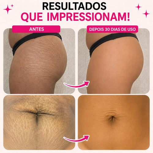 BellaFirm™ Tratamento Intensivo para Estrias e Flacidez