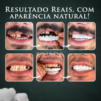 Facetas Dentárias Removíveis Naturais ®Nature Smile