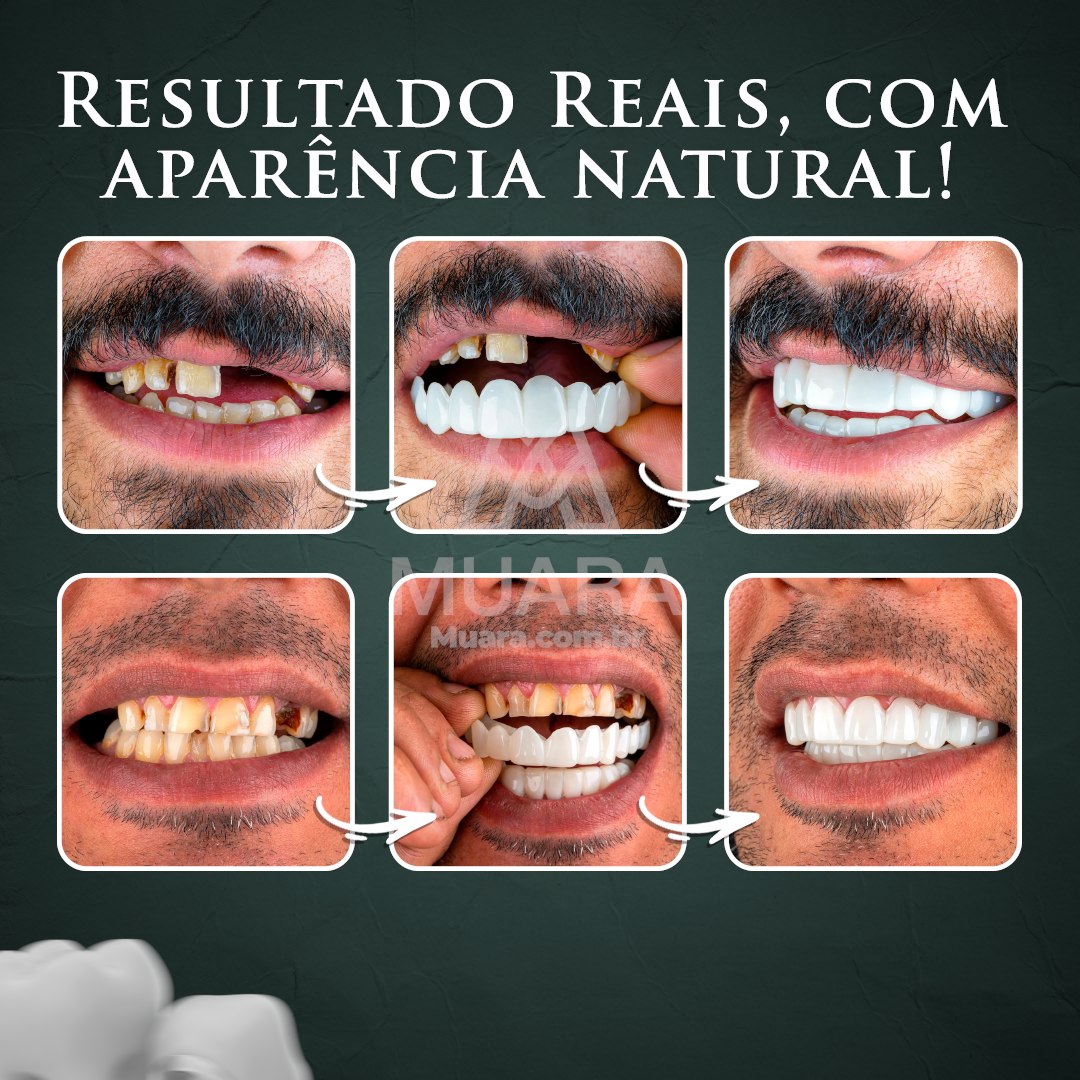Facetas Dentárias Removíveis Naturais ®Nature Smile